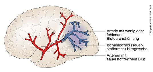 Hirninfarkt (Schlaganfall durch Gefäßverschluss) Hirninfarkt (Schlaganfall durch Gefäßverschluss)